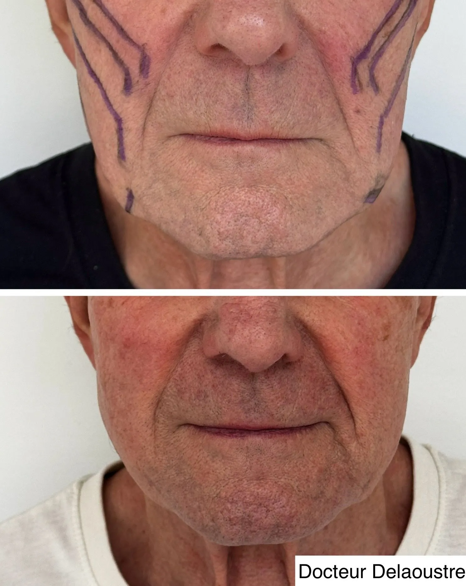 Fils crantés, avant / après : bas du visage de face, avec le tracé des vecteurs au crayon