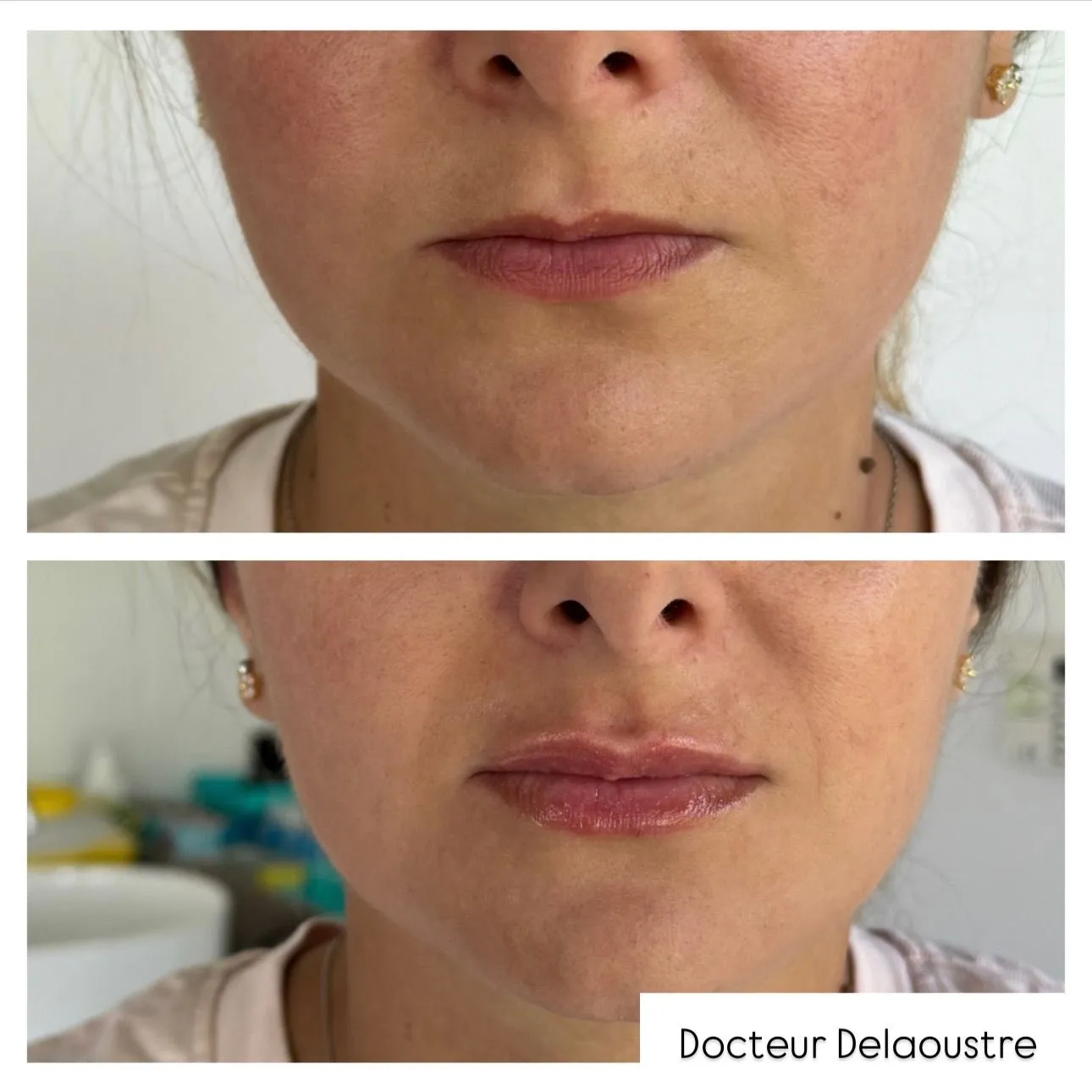 Injections des lèvres, avant / après : bas du visage, de face