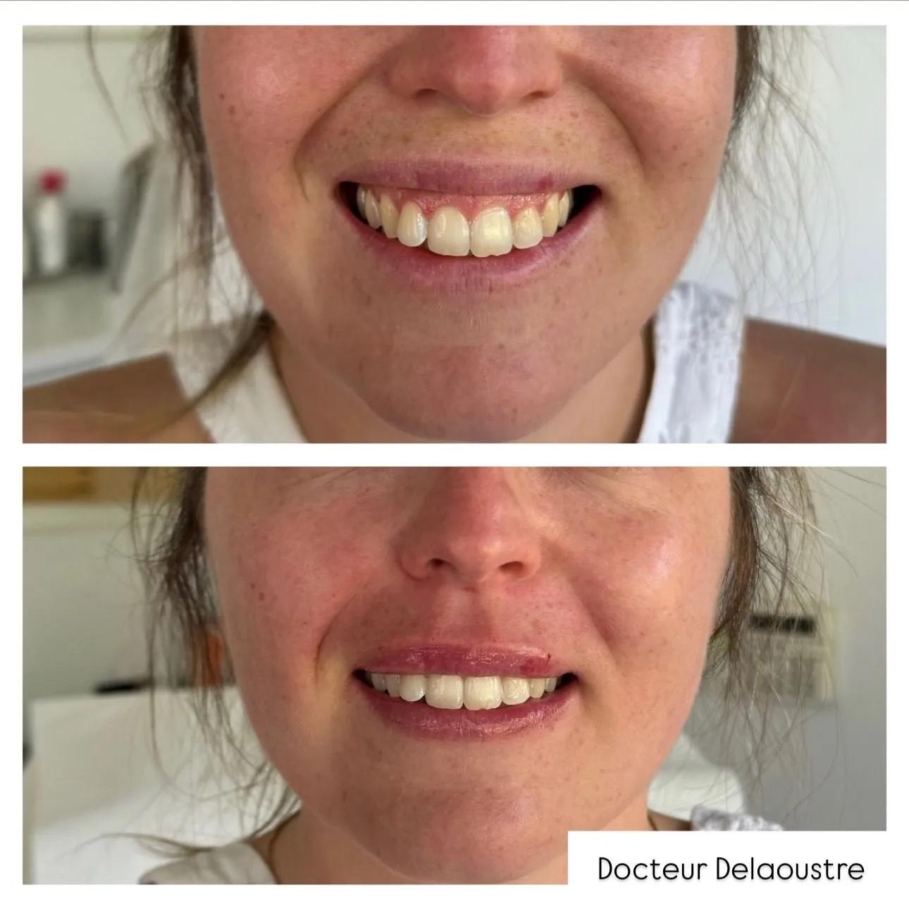 Injections des lèvres, avant / après : sourire, de face