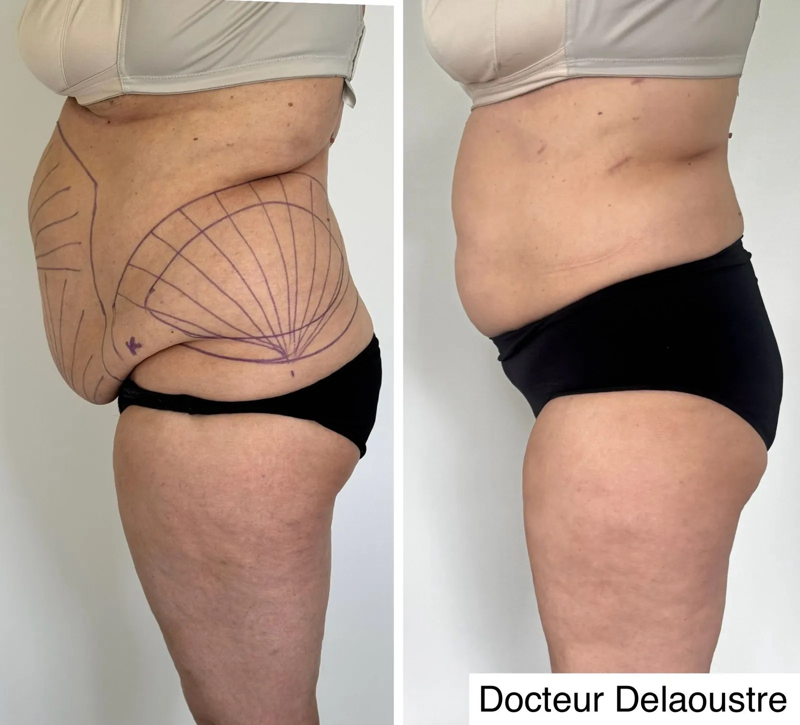 Liposculpture, avant / après : ventre et hanches de profil, avec le tracé au crayon