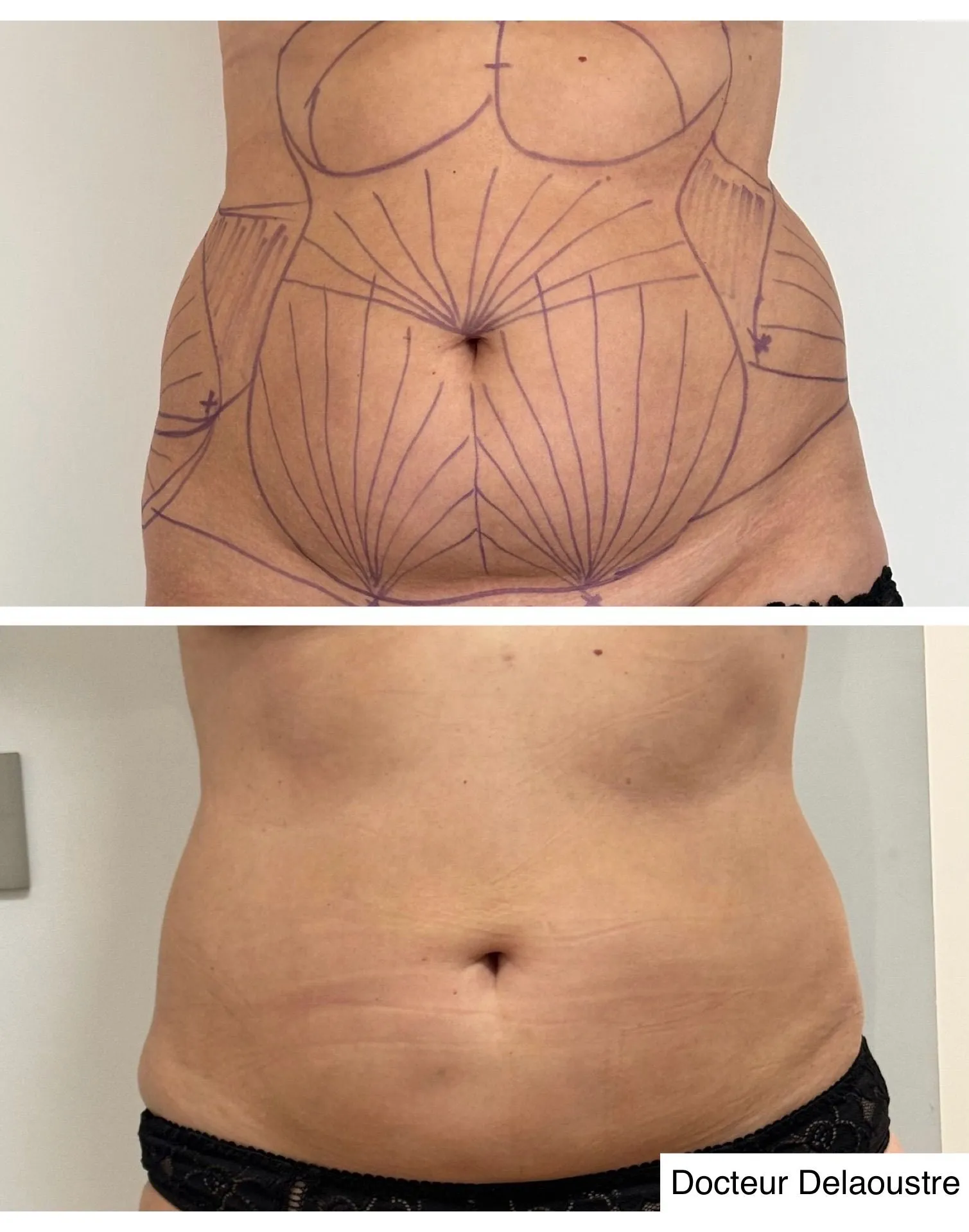 Liposculpture, avant / après : ventre, de face