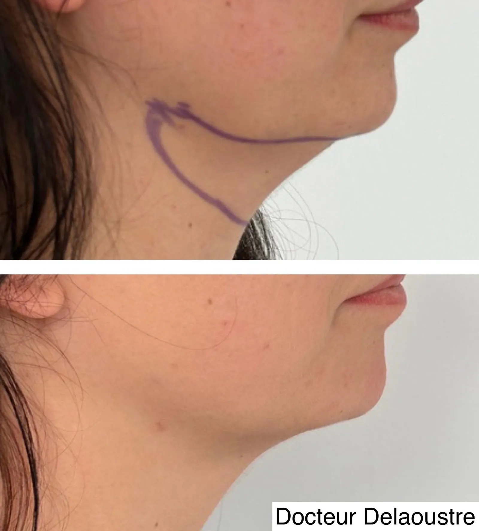 Liposculpture, avant / après : double menton, de profil