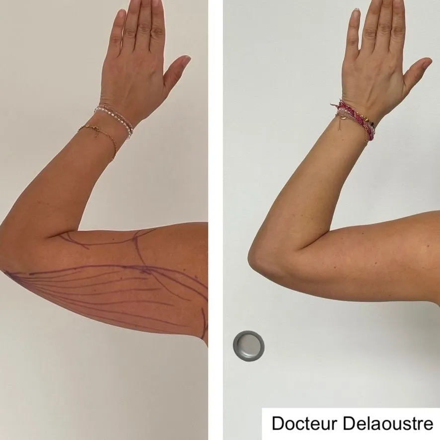 Liposculpture, avant / après : bras