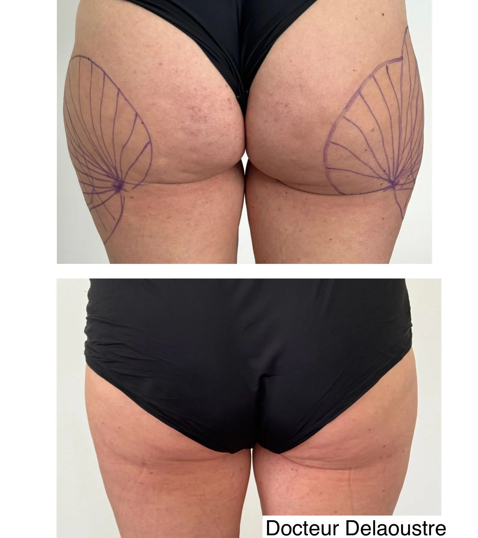 Liposculpture, avant / après : hanches et cuisses, de dos