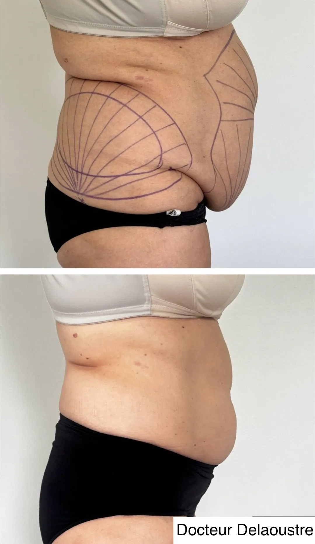 Liposculpture, avant / après : ventre, de profil
