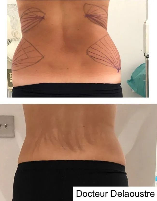 Liposculpture, avant / après : bas du dos et hanches