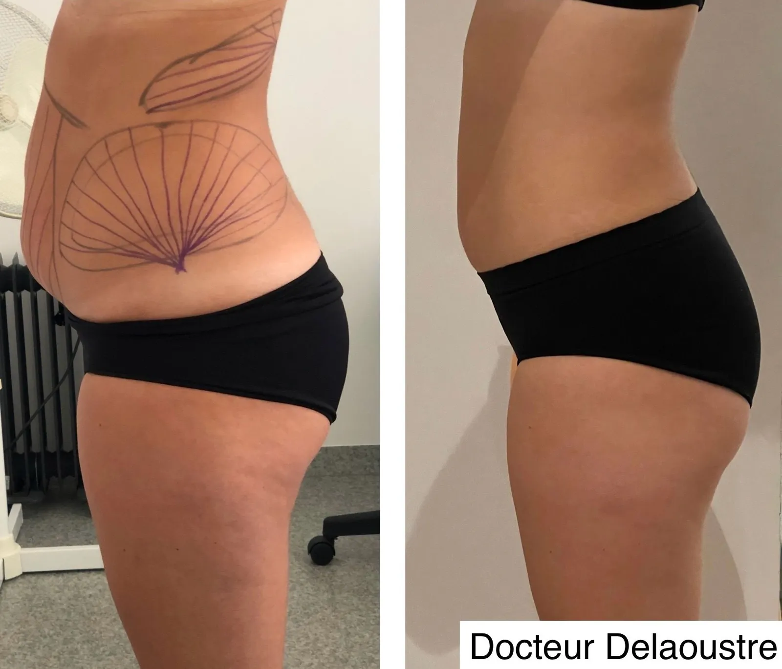 Liposculpture, avant / après : ventre et hanches, de profil