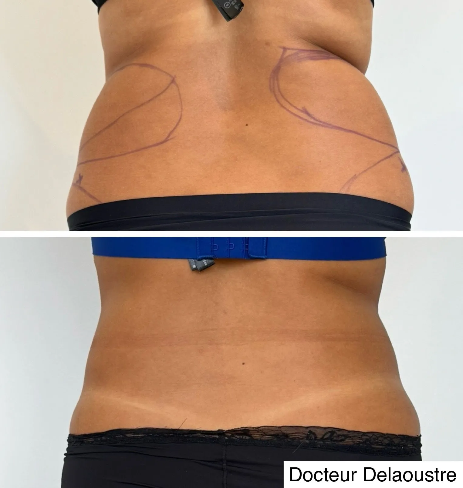 Liposculpture, avant / après : bas du dos et hanches, de dos
