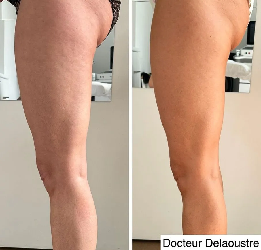 LPG, avant / après : arrière des jambes