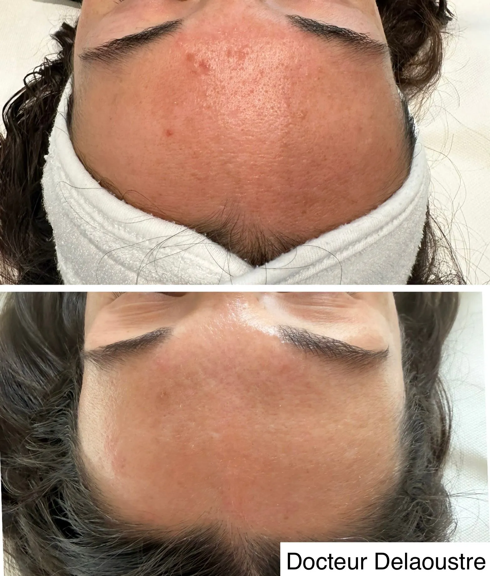 Peeling, avant / après : front et sourcils