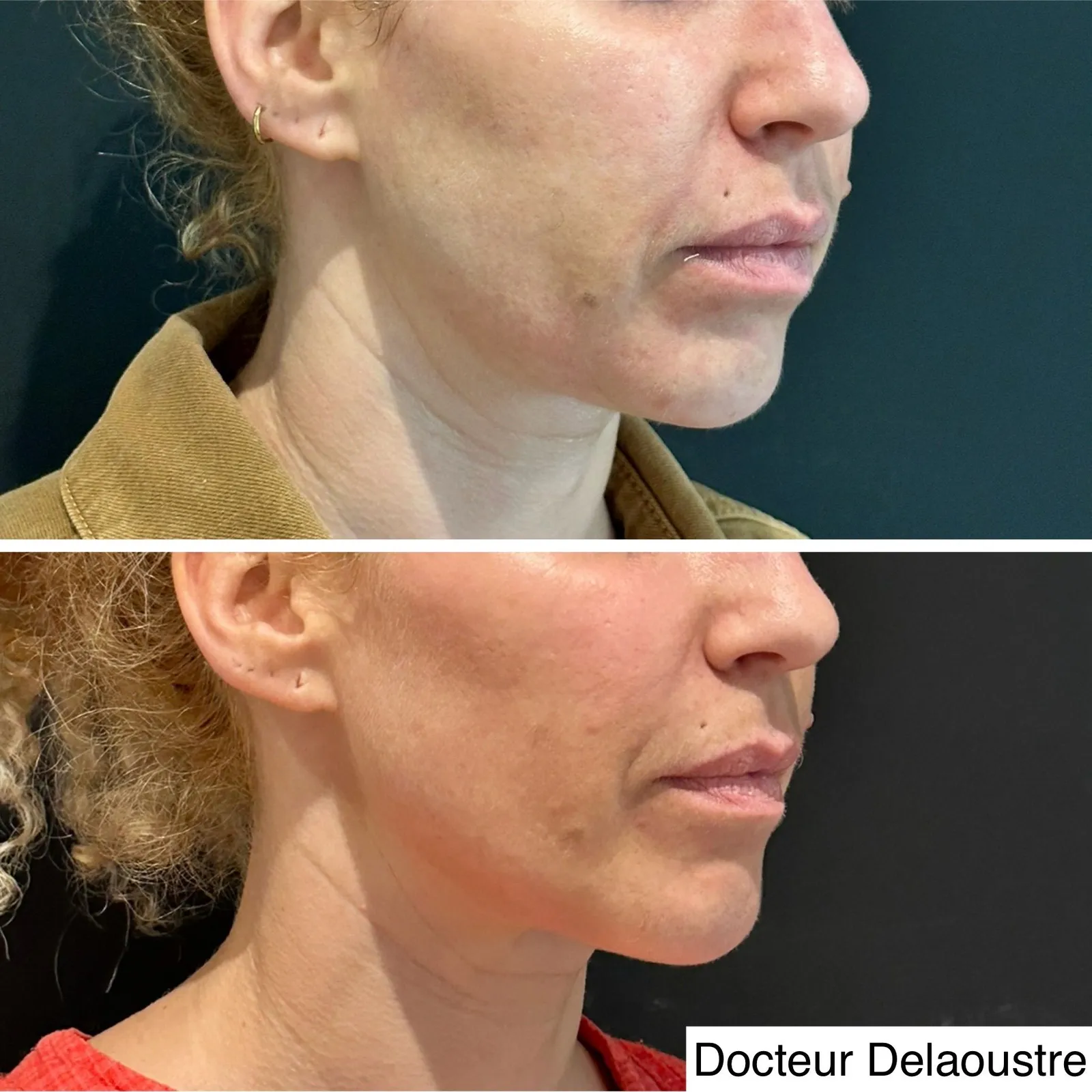 Ulthérapie, avant / après : bas du visage et cou, de trois quarts